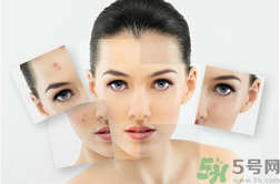 下巴長硬包是怎么回事？下巴長硬包怎么辦？