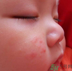 寶寶長蘚是怎么回事？寶寶長蘚怎么辦？