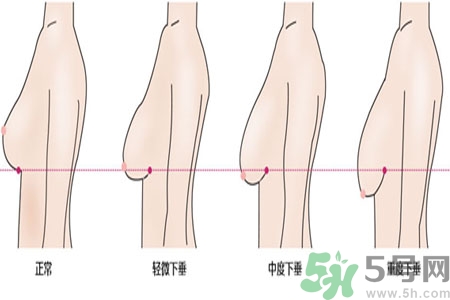 ?女性乳房下垂的原因是什么？女性乳房下垂的分類有哪些？