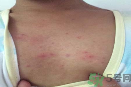 胸部長痘痘怎么回事？胸部長痘痘的原因是什么？