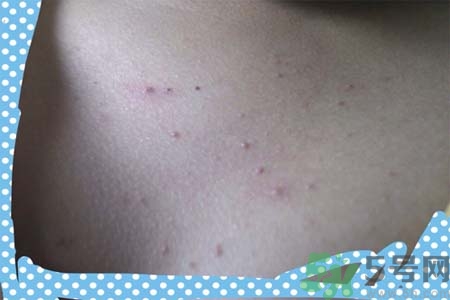 胸部長痘痘怎么回事？胸部長痘痘的原因是什么？