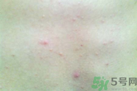 胸部長痘痘怎么回事？胸部長痘痘的原因是什么？