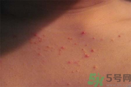 胸部長痘痘怎么辦？胸部長痘痘需要注意什么？