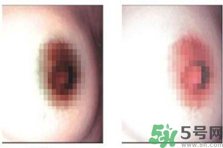 乳頭發(fā)黑怎么辦？怎么樣可以使乳頭變白？