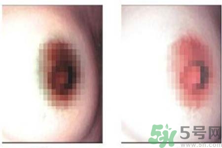 乳頭發(fā)黑是怎么回事？乳頭發(fā)黑是什么原因？