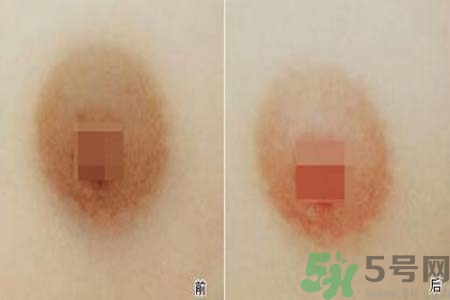乳頭發(fā)黑是怎么回事？乳頭發(fā)黑是什么原因？