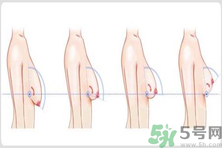 胸部松弛的原因是什么？胸部松弛該怎么辦？