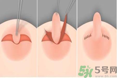 乳頭內(nèi)陷怎么回事？乳頭內(nèi)陷的原因是什么？