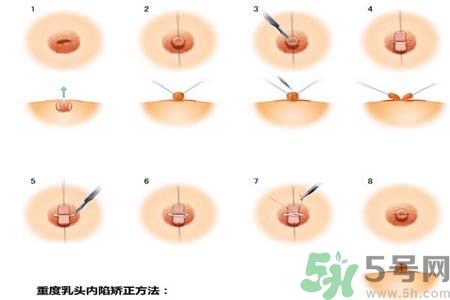 乳頭內(nèi)陷怎么回事？乳頭內(nèi)陷的原因是什么？
