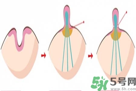 乳頭內(nèi)陷怎么辦？乳頭內(nèi)陷的癥狀有哪些？
