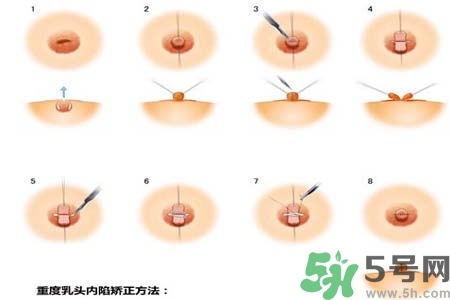 乳頭內(nèi)陷怎么辦？乳頭內(nèi)陷的癥狀有哪些？