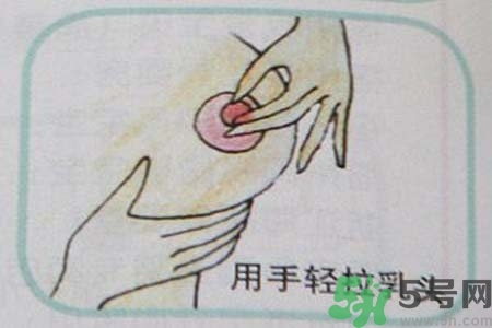 乳頭內(nèi)陷怎么辦？乳頭內(nèi)陷的癥狀有哪些？