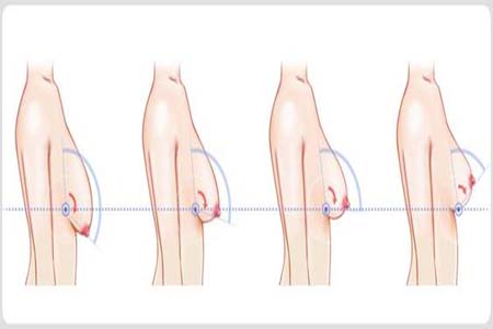 胸部松弛的原因是什么？胸部松弛該怎么辦？