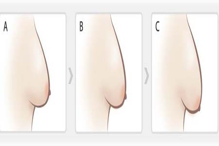 如何預(yù)防胸部松弛？吃什么能使胸部挺拔？