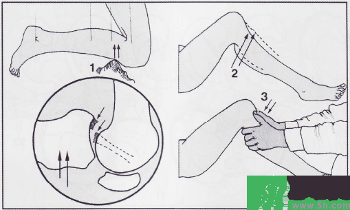 韌帶斷裂吃什么好得快？前十字韌帶斷裂吃什么補(bǔ)品？