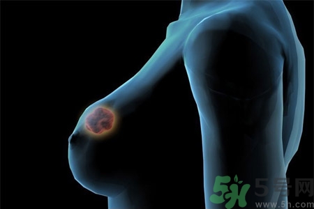 乳房有硬塊正常嗎？乳房有腫塊怎么回事？