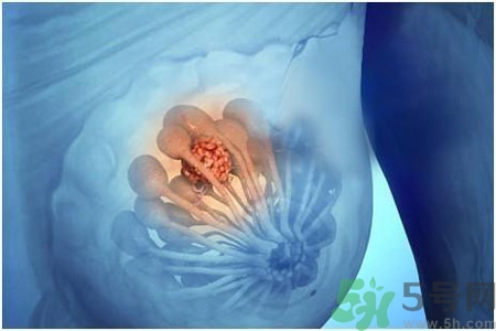 乳房屋硬塊有疼痛感怎么回事？乳房屋硬塊有疼痛感怎么辦？