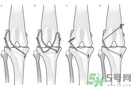 前十字韌帶斷裂可以參加比賽嗎？前十字韌帶斷裂怎么治療？