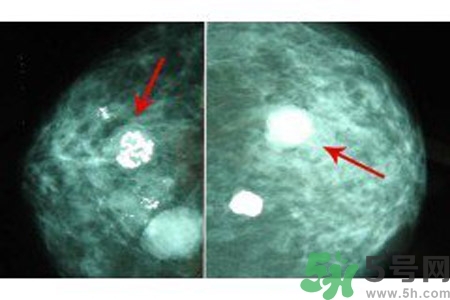 產(chǎn)生乳腺增生鈣化的病因是什么？乳腺增生怎樣治療？