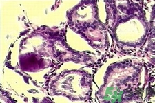 產(chǎn)生乳腺增生鈣化的病因是什么？乳腺增生怎樣治療？