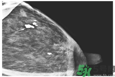 產(chǎn)生乳腺增生鈣化的病因是什么？乳腺增生怎樣治療？