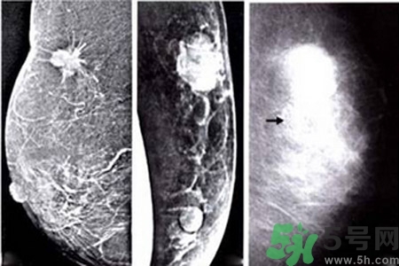 乳腺增生鈣化是什么？乳腺鈣化的癥狀有哪些？