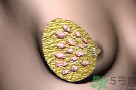 產(chǎn)生乳腺增生鈣化的病因是什么？乳腺增生怎樣治療？