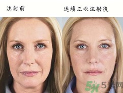 3D液態(tài)拉皮多少錢？3D液態(tài)拉皮后多久見效？