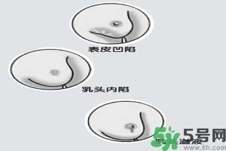 乳頭內陷怎么矯正？乳頭內陷矯正方法是什么？