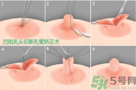 乳頭內陷怎么矯正？乳頭內陷矯正方法是什么？