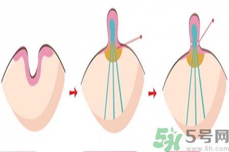 乳頭內(nèi)陷矯正需注意什么？乳頭內(nèi)陷如何預(yù)防？