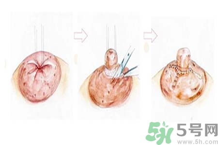 乳頭內(nèi)陷矯正需注意什么？乳頭內(nèi)陷如何預(yù)防？