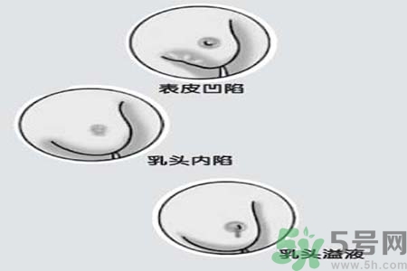 乳頭內(nèi)陷矯正需注意什么？乳頭內(nèi)陷如何預(yù)防？