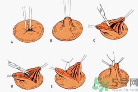 乳頭內(nèi)陷能不能喂奶？乳頭凹陷怎樣哺乳？