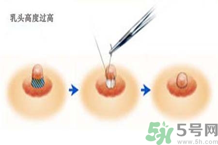 乳頭內(nèi)陷能不能喂奶？乳頭凹陷怎樣哺乳？