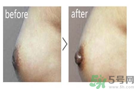 乳頭內(nèi)陷可以用吸奶器嗎？乳頭內(nèi)陷能不能用吸奶器？