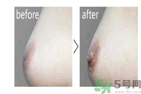 乳頭內(nèi)陷可以用吸奶器嗎？乳頭內(nèi)陷能不能用吸奶器？