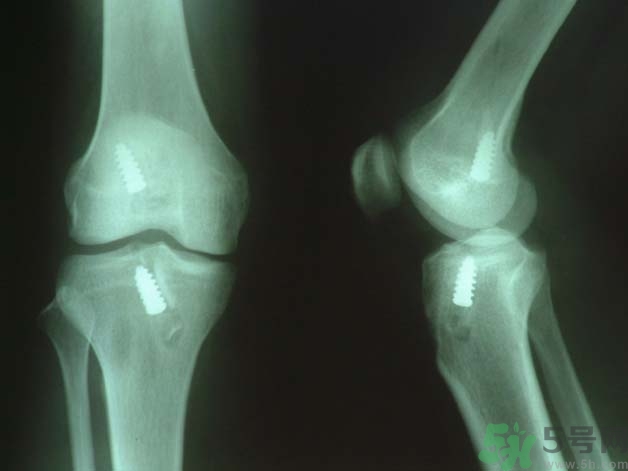 韌帶斷裂吃什么好得快？前十字韌帶斷裂吃什么補(bǔ)品？