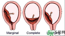陰道出血和什么有關(guān)？陰道出血的應(yīng)急措施有哪些？