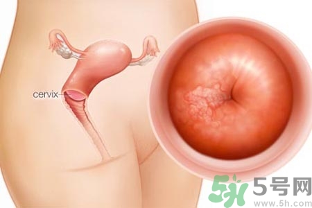 陰道松弛是什么？陰道松弛的癥狀有哪些？