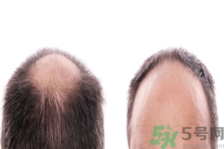頭發(fā)稀少的原因是什么？如何預防禿頂?shù)陌l(fā)生？