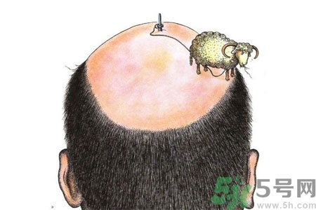 頭發(fā)稀少的原因是什么？如何預防禿頂?shù)陌l(fā)生？