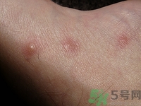 后背長痘能拔罐嗎?拔罐能祛痘嗎 后背長痘能拔罐嗎?拔罐能祛痘嗎