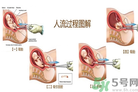 人工流產(chǎn)后多久可以再次懷孕？流產(chǎn)后需要注意什么？