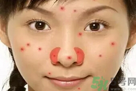 鼻翼長痘痘怎么回事？鼻翼長痘痘的原因是什么？