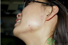 腮幫子長(zhǎng)痘痘是什么原因？腮幫子長(zhǎng)痘痘怎么調(diào)理？