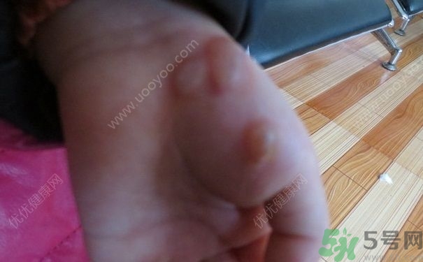 15歲還會(huì)得手足口病嗎？手足口病的癥狀有哪些？