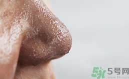 什么原因?qū)е路鄞?導(dǎo)致黑頭粉刺特殊原因介紹 什么原因?qū)е路鄞?導(dǎo)致黑頭粉刺特殊原因介紹