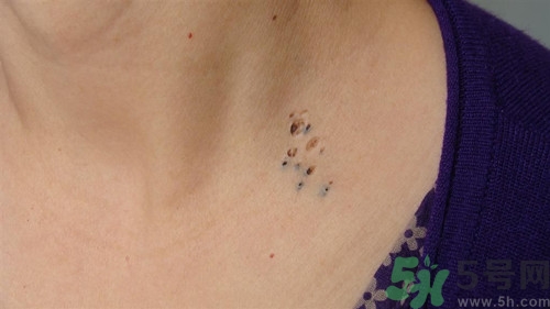 什么原因?qū)е路鄞?導(dǎo)致黑頭粉刺特殊原因介紹 什么原因?qū)е路鄞?導(dǎo)致黑頭粉刺特殊原因介紹