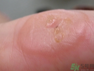 手上長水泡是什么原因?手上長水泡很癢怎么辦?